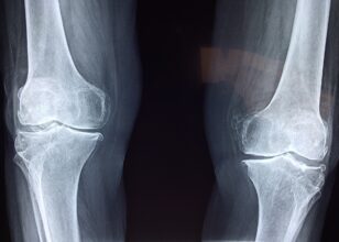 Understanding Orthopedic Surgery: Procedures, Risks, and Recovery